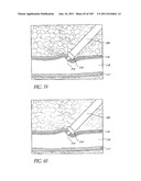 TISSUE CLOSURE DEVICES, DEVICE AND SYSTEMS FOR DELIVERY, KITS AND METHODS     THEREFOR diagram and image