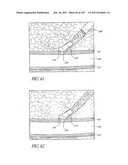 TISSUE CLOSURE DEVICES, DEVICE AND SYSTEMS FOR DELIVERY, KITS AND METHODS     THEREFOR diagram and image