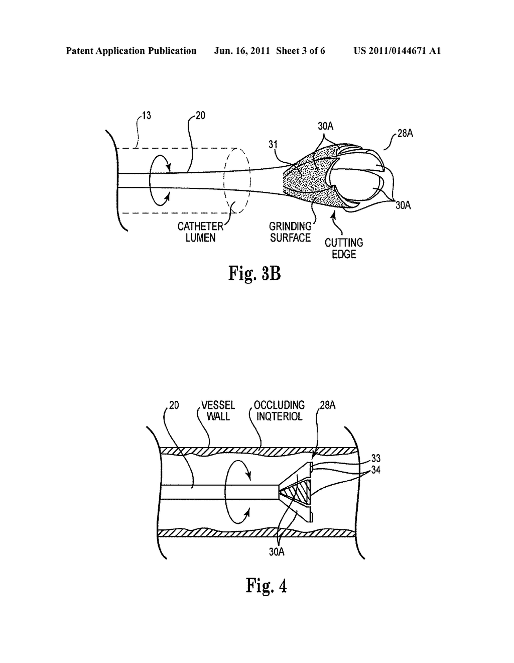 ATHERECTOMY DEVICE, SYSTEM AND METHOD HAVING A BI-DIRECTIONAL DISTAL     EXPANDABLE ABLATION ELEMENT - diagram, schematic, and image 04