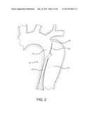 METHOD OF USING AN AORTIC DISSECTION SEPTAL CUTTING TOOL diagram and image