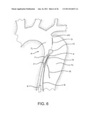METHOD OF USING AN AORTIC DISSECTION SEPTAL CUTTING TOOL diagram and image