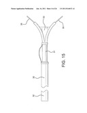 METHOD OF USING AN AORTIC DISSECTION SEPTAL CUTTING TOOL diagram and image