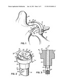 ATTACHMENT DEVICES AND METHODS FOR SPINAL IMPLANTS diagram and image