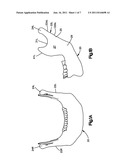 Mandibular Fixation Plate diagram and image