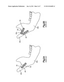 Mandibular Fixation Plate diagram and image