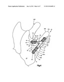 Mandibular Fixation Plate diagram and image