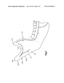 Mandibular Fixation Plate diagram and image