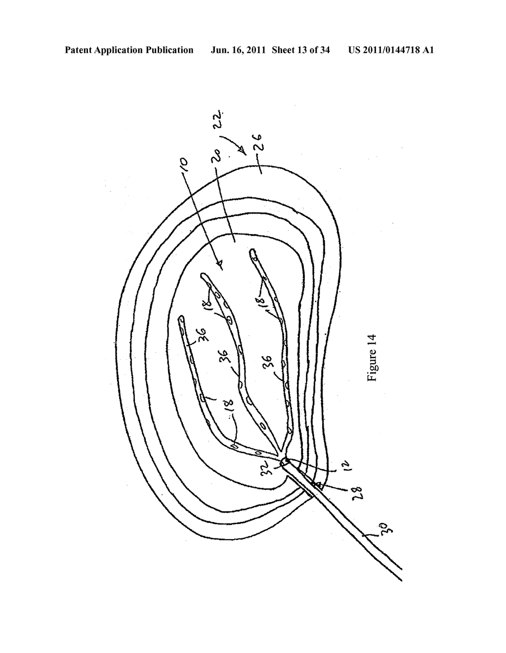 COMPOSITION AND METHOD FOR THE TREATMENT OR PREVENTION OF SPINAL DISORDERS - diagram, schematic, and image 14