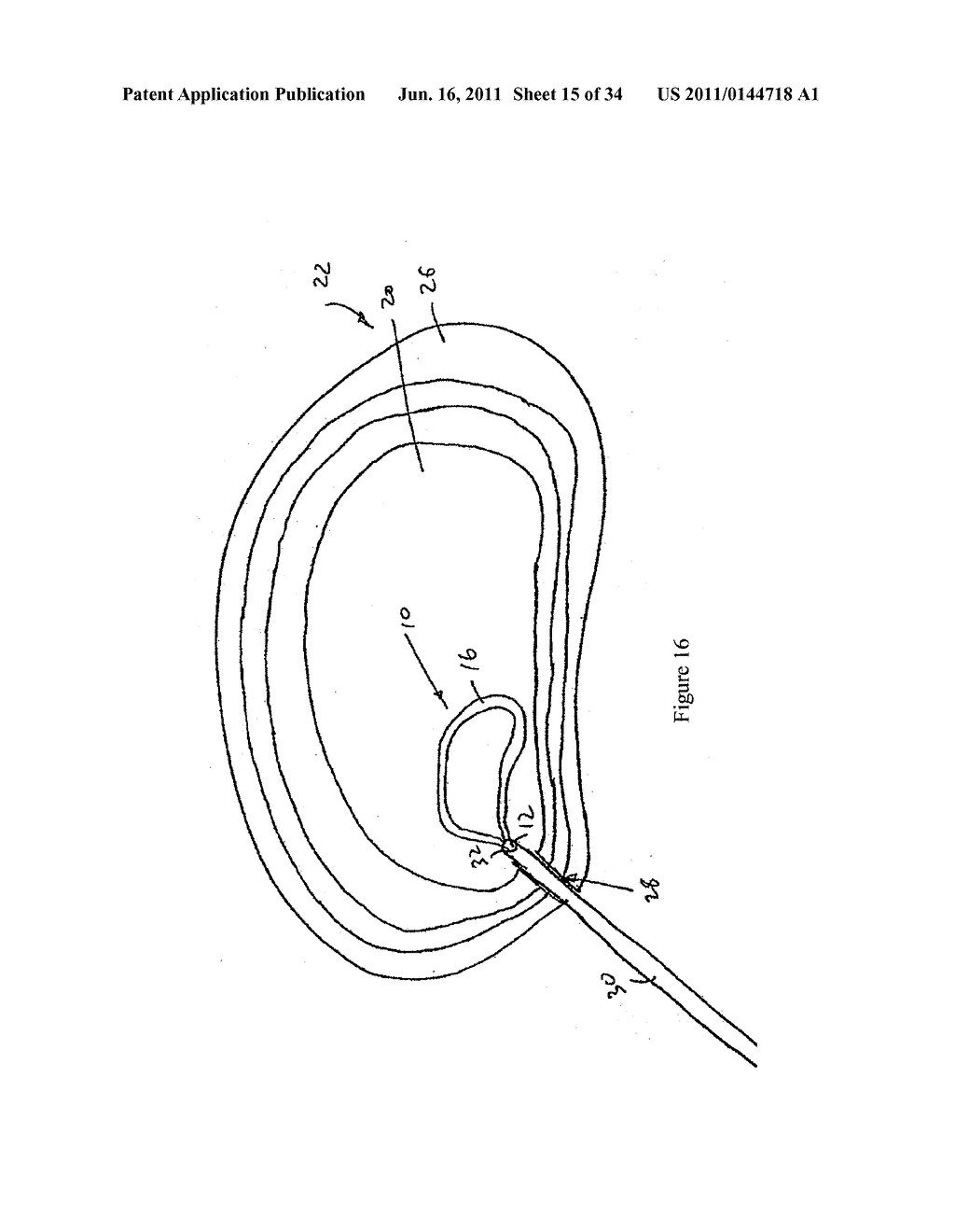 COMPOSITION AND METHOD FOR THE TREATMENT OR PREVENTION OF SPINAL DISORDERS - diagram, schematic, and image 16