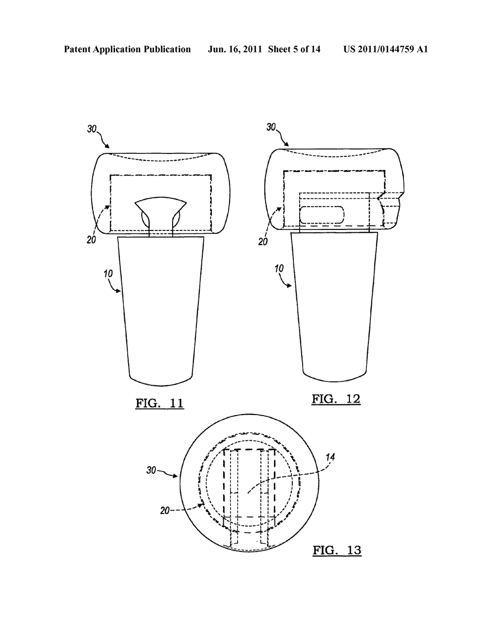 MODULAR PROSTHESIS AND USE THEREOF FOR REPLACING A RADIAL HEAD - diagram, schematic, and image 06