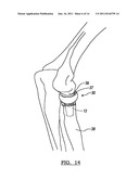 MODULAR PROSTHESIS AND USE THEREOF FOR REPLACING A RADIAL HEAD diagram and image