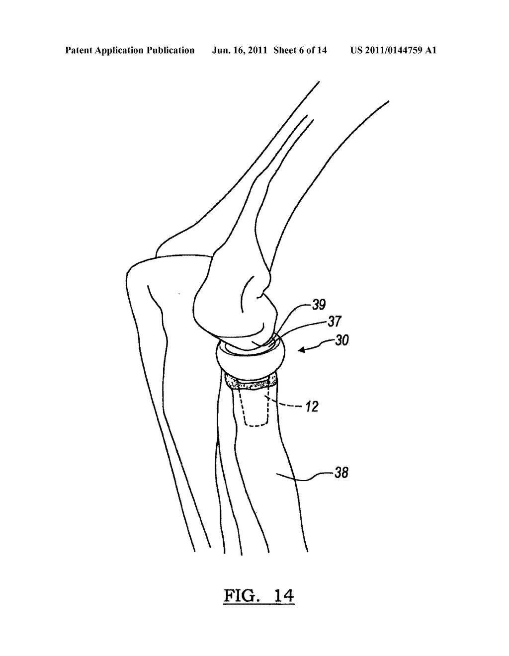 MODULAR PROSTHESIS AND USE THEREOF FOR REPLACING A RADIAL HEAD - diagram, schematic, and image 07