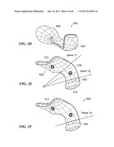 Patient-Specific and Patient-Engineered Orthopedic Implants diagram and image