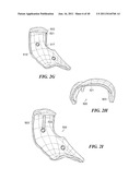 Patient-Specific and Patient-Engineered Orthopedic Implants diagram and image