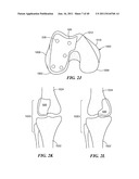 Patient-Specific and Patient-Engineered Orthopedic Implants diagram and image