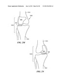 Patient-Specific and Patient-Engineered Orthopedic Implants diagram and image