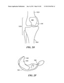 Patient-Specific and Patient-Engineered Orthopedic Implants diagram and image