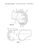 Patient-Specific and Patient-Engineered Orthopedic Implants diagram and image