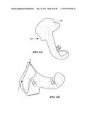 Patient-Specific and Patient-Engineered Orthopedic Implants diagram and image