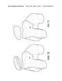 Patient-Specific and Patient-Engineered Orthopedic Implants diagram and image