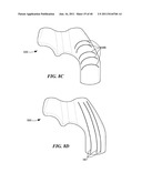 Patient-Specific and Patient-Engineered Orthopedic Implants diagram and image