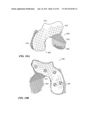 Patient-Specific and Patient-Engineered Orthopedic Implants diagram and image