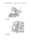 Patient-Specific and Patient-Engineered Orthopedic Implants diagram and image