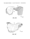 Patient-Specific and Patient-Engineered Orthopedic Implants diagram and image