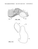 Patient-Specific and Patient-Engineered Orthopedic Implants diagram and image