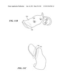 Patient-Specific and Patient-Engineered Orthopedic Implants diagram and image