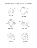 Patient-Specific and Patient-Engineered Orthopedic Implants diagram and image