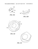 Patient-Specific and Patient-Engineered Orthopedic Implants diagram and image