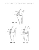 Patient-Specific and Patient-Engineered Orthopedic Implants diagram and image