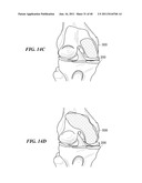 Patient-Specific and Patient-Engineered Orthopedic Implants diagram and image