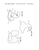 Patient-Specific and Patient-Engineered Orthopedic Implants diagram and image