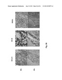 METHODS FOR DIAGNOSIS, PROGNOSIS AND TREATMENT OF PRIMARY AND METASTATIC     BASAL-LIKE BREAST CANCER AND OTHER CANCER TYPES diagram and image