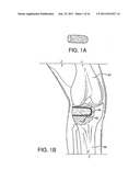 STRONTIUM-DOPED CALCIUM PHOSPHATE BONE GRAFT MATERIALS diagram and image