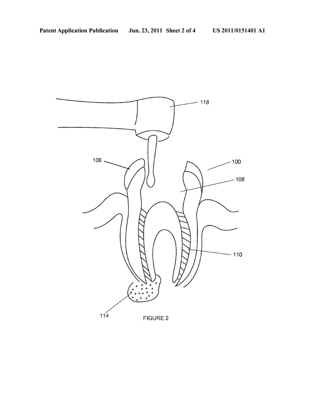 SINGLE COMPONENT TOOTH ROOT SEALER - diagram, schematic, and image 03