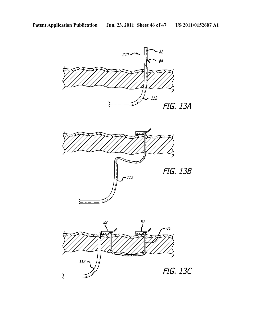 Apparatus and Method for Manipulating or Retracting Tissue and Anatomical     Structure - diagram, schematic, and image 47