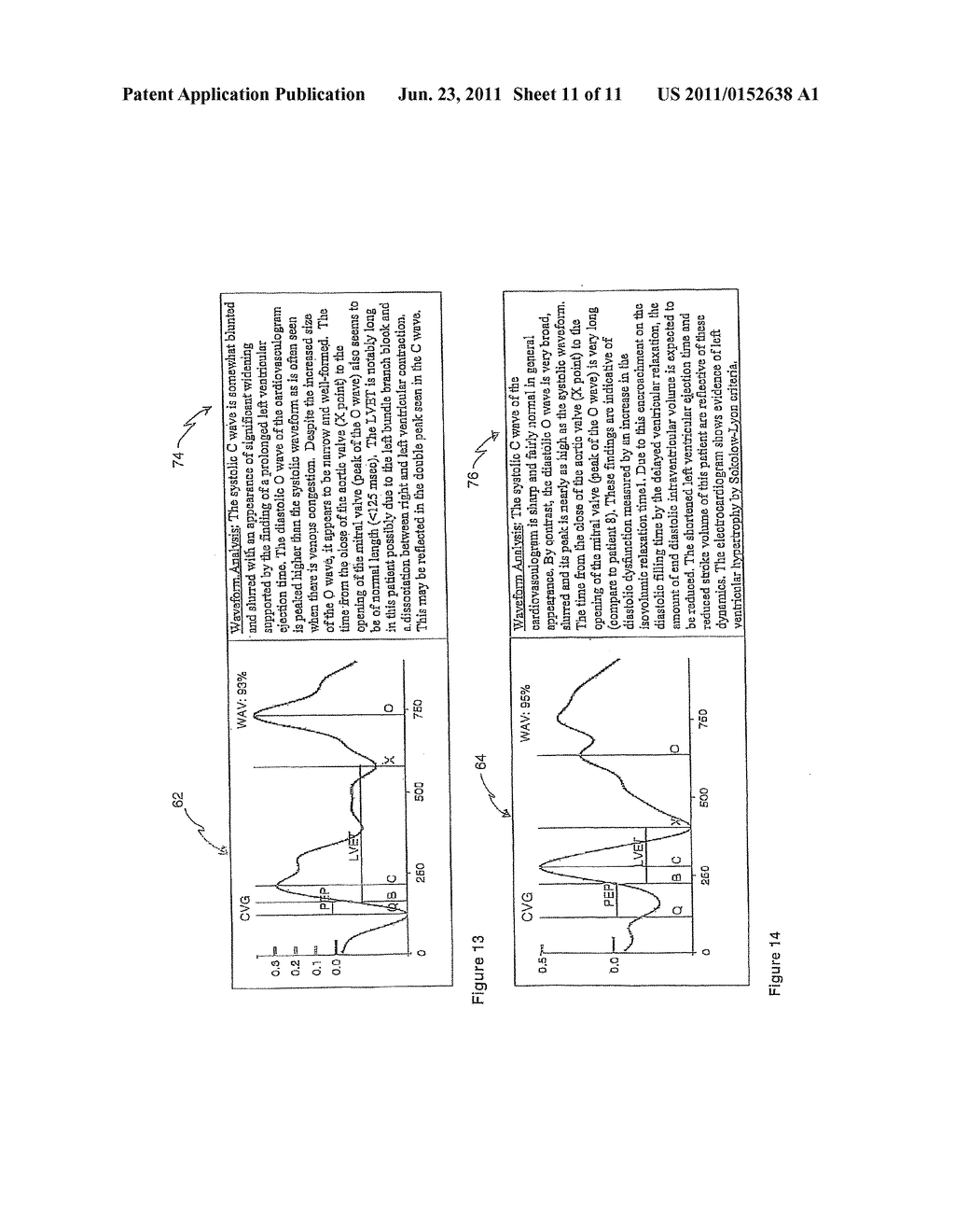 CARDIOGRAPHY SYSTEM AND METHOD USING AUTOMATED RECOGNITION OF HEMODYNAMIC     PARAMETERS AND WAVEFORM ATTRIBUTES - diagram, schematic, and image 12