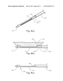 BIOPSY NEEDLE WITH VACUUM ASSIST diagram and image