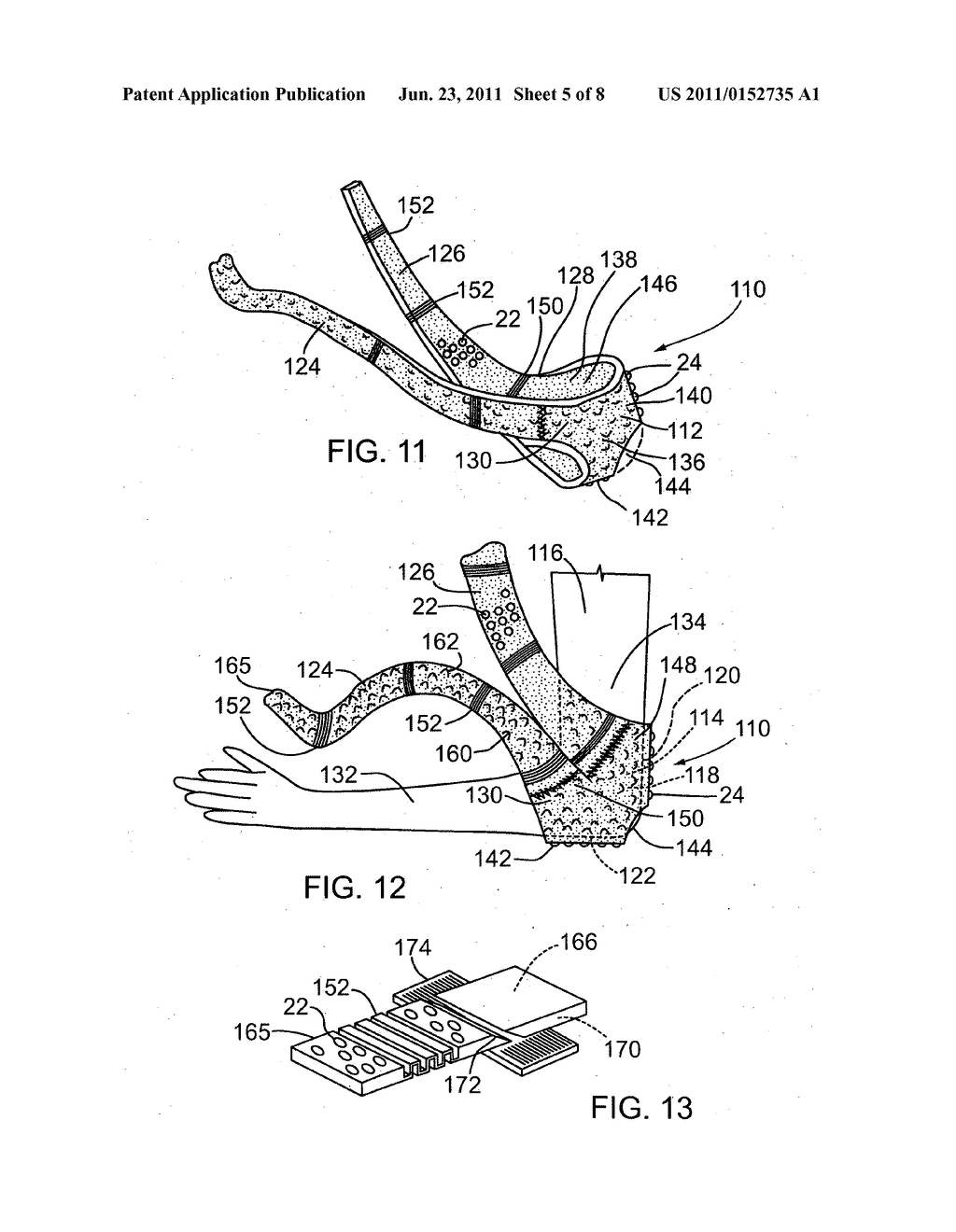 SURGICAL CAST VENTING DEVICE AND MATERIAL - diagram, schematic, and image 06