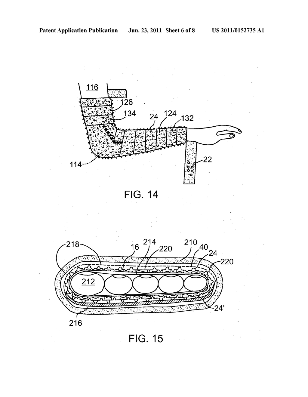 SURGICAL CAST VENTING DEVICE AND MATERIAL - diagram, schematic, and image 07