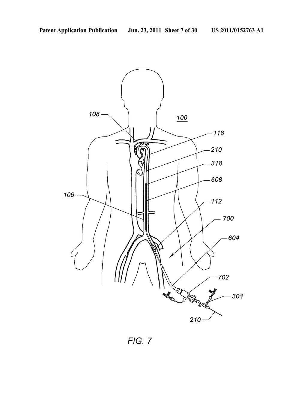 EXPANDABLE ILIAC SHEATH AND METHOD OF USE - diagram, schematic, and image 08