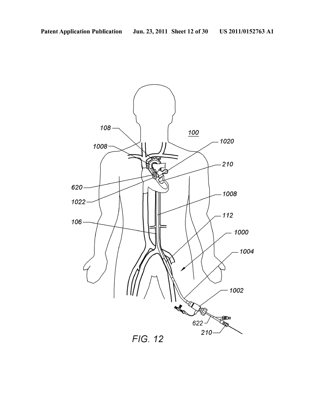 EXPANDABLE ILIAC SHEATH AND METHOD OF USE - diagram, schematic, and image 13