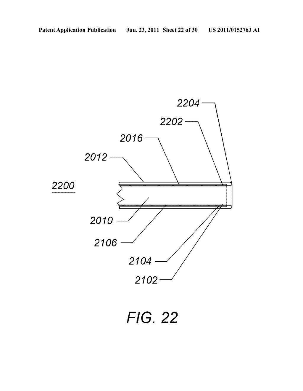 EXPANDABLE ILIAC SHEATH AND METHOD OF USE - diagram, schematic, and image 23