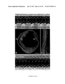 METHODS AND COMPOSITIONS FOR THE REPAIR AND/OR REGENERATION OF DAMAGED     MYOCARDIUM diagram and image