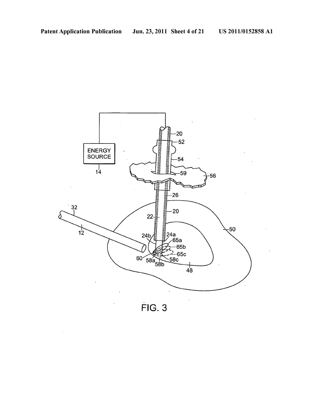 SURGICAL INSTRUMENT COMPRISING AN ELECTRODE - diagram, schematic, and image 05