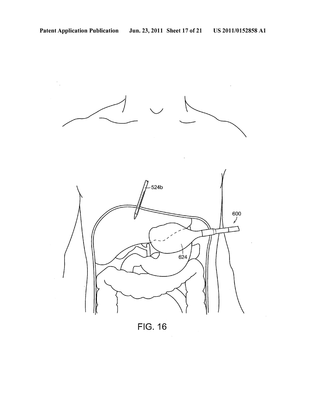 SURGICAL INSTRUMENT COMPRISING AN ELECTRODE - diagram, schematic, and image 18