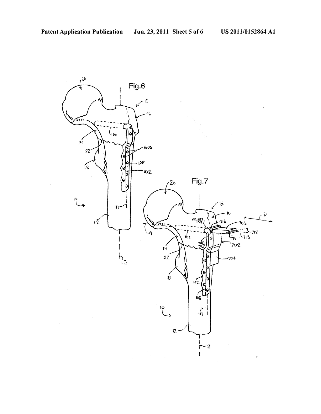 BONE FIXATION SYSTEM - diagram, schematic, and image 06